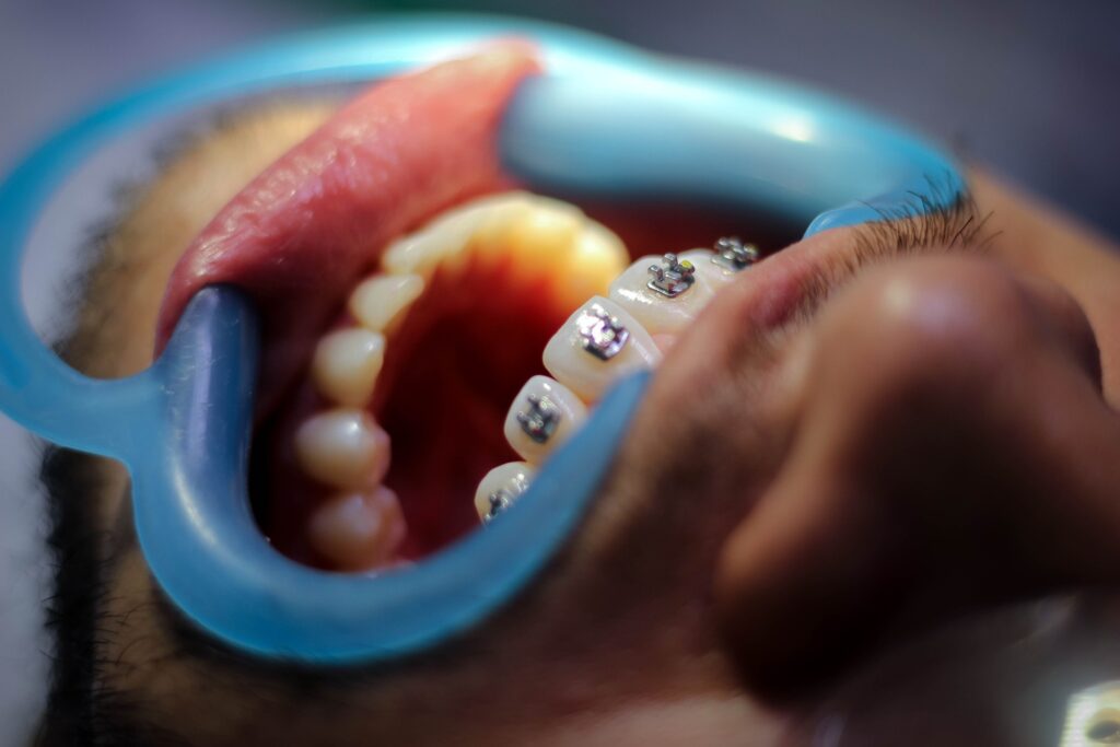 appareil dentaire saphir Turquie